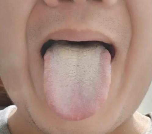 出现这样的舌象，身体不虚才怪！白腻苔糊满了整个舌头
患者说：肾虚的很，那方面功能