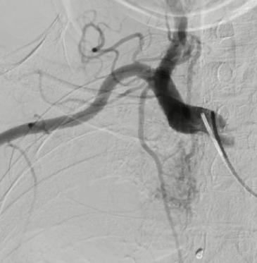 左上肺癌，锁骨上动脉造影，甲状颈干分支供应左上肺癌，反复使用单弯导管无法勾到责任血管，单弯导管热蒸汽成形后成功找到责任血管，微导管超选后CBCT证实肿瘤染色丰富后进行微球栓塞。