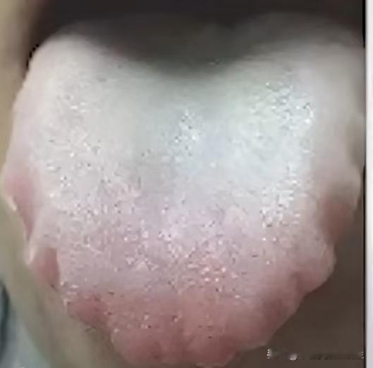 齿痕舌加白腻苔，别再乱吃药了，不疏通淤堵，不论怎么补也只是拆东墙补西墙

看这个