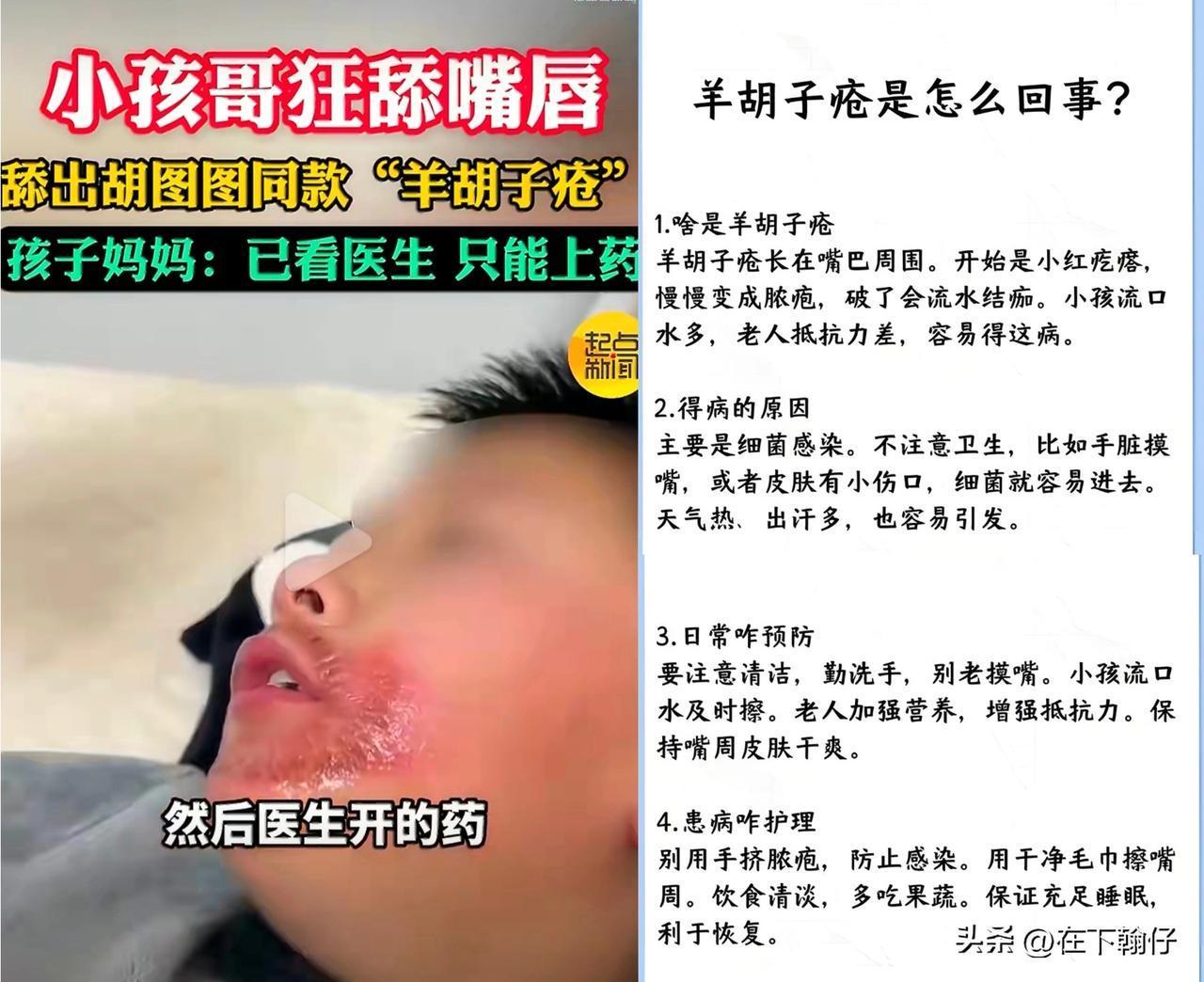 安徽一名10岁男孩因反复舔舐干燥的嘴唇，导致唇周出现一圈边界清晰的红疹与色素沉着