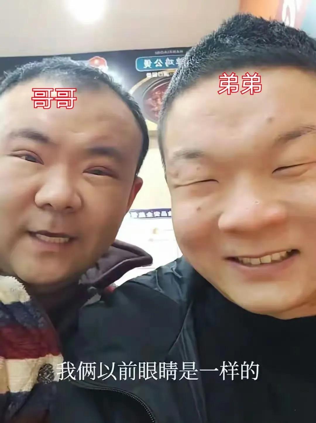 河南开封，一位40岁大哥带弟弟去割双眼皮，结果弟弟临阵退缩，哥哥做了双眼皮手术，