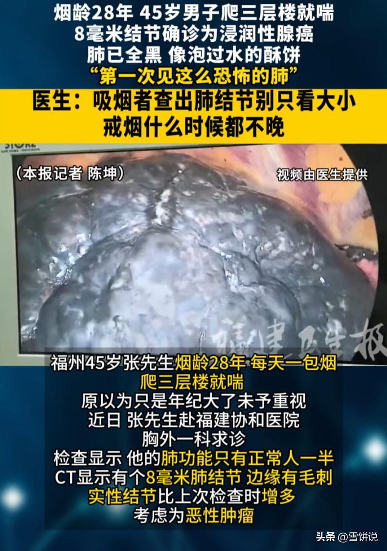 45岁福州男子，烟龄28年，日均一包烟。常年爬三层楼梯就气喘吁吁，自认是年纪增长
