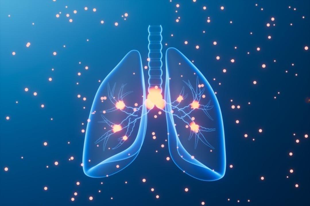 中晚期肺癌不要气馁，治疗后再做手术也有可能根治，肺癌治疗，要想根治首推手术。但有