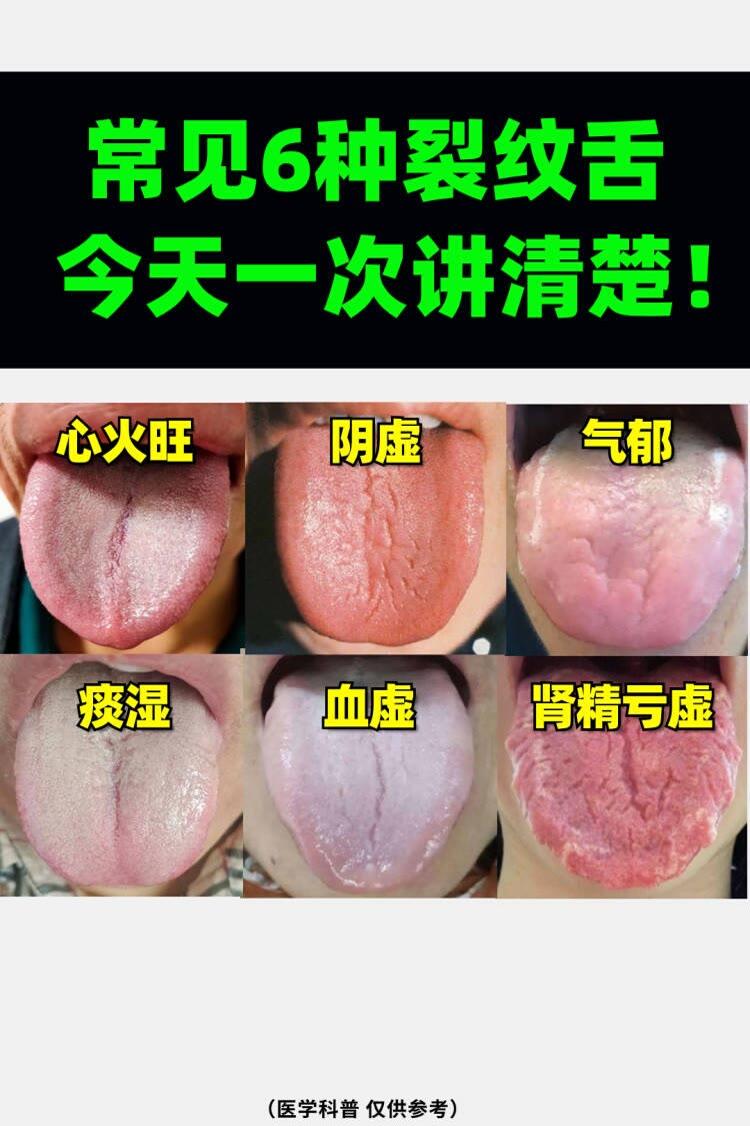 日常6大裂纹舌！老中医一次给你讲明白[中国赞]
如果舌头出现，像下面这样的裂纹，