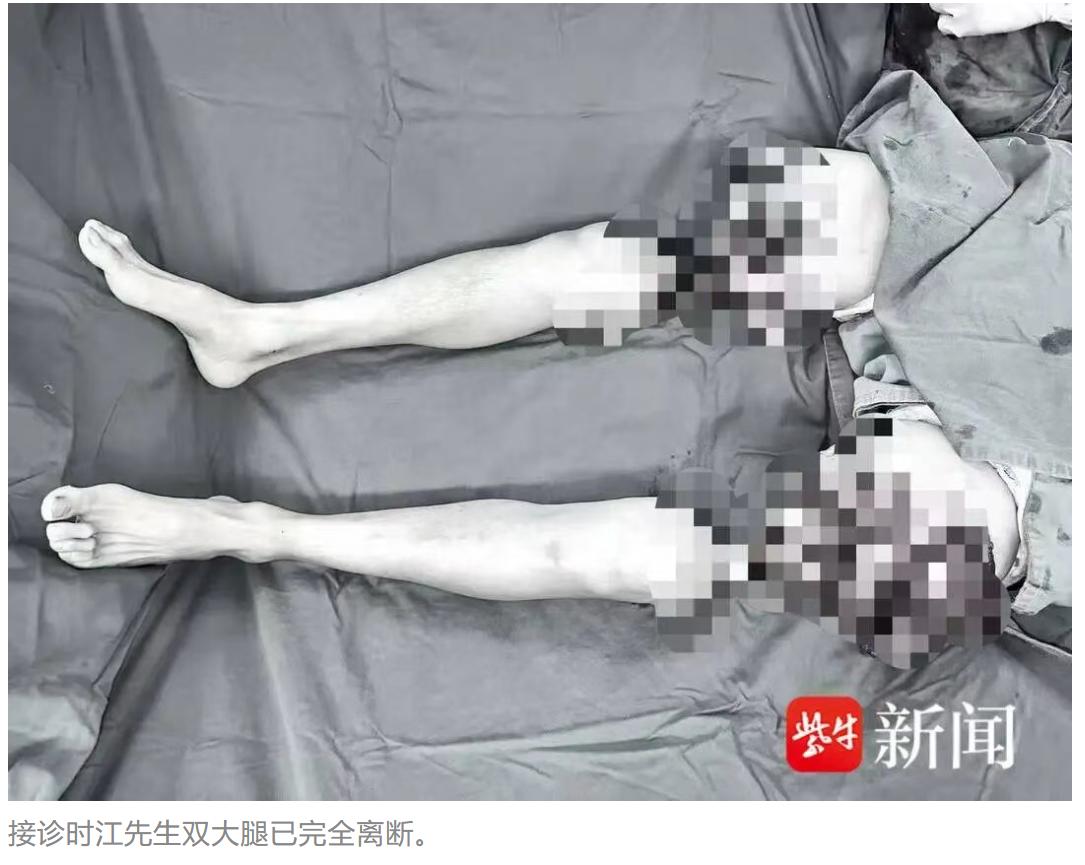 一则双大腿重度外伤离体再植的医学突破案例，引发大众广泛关注。51 岁的江先生遭遇