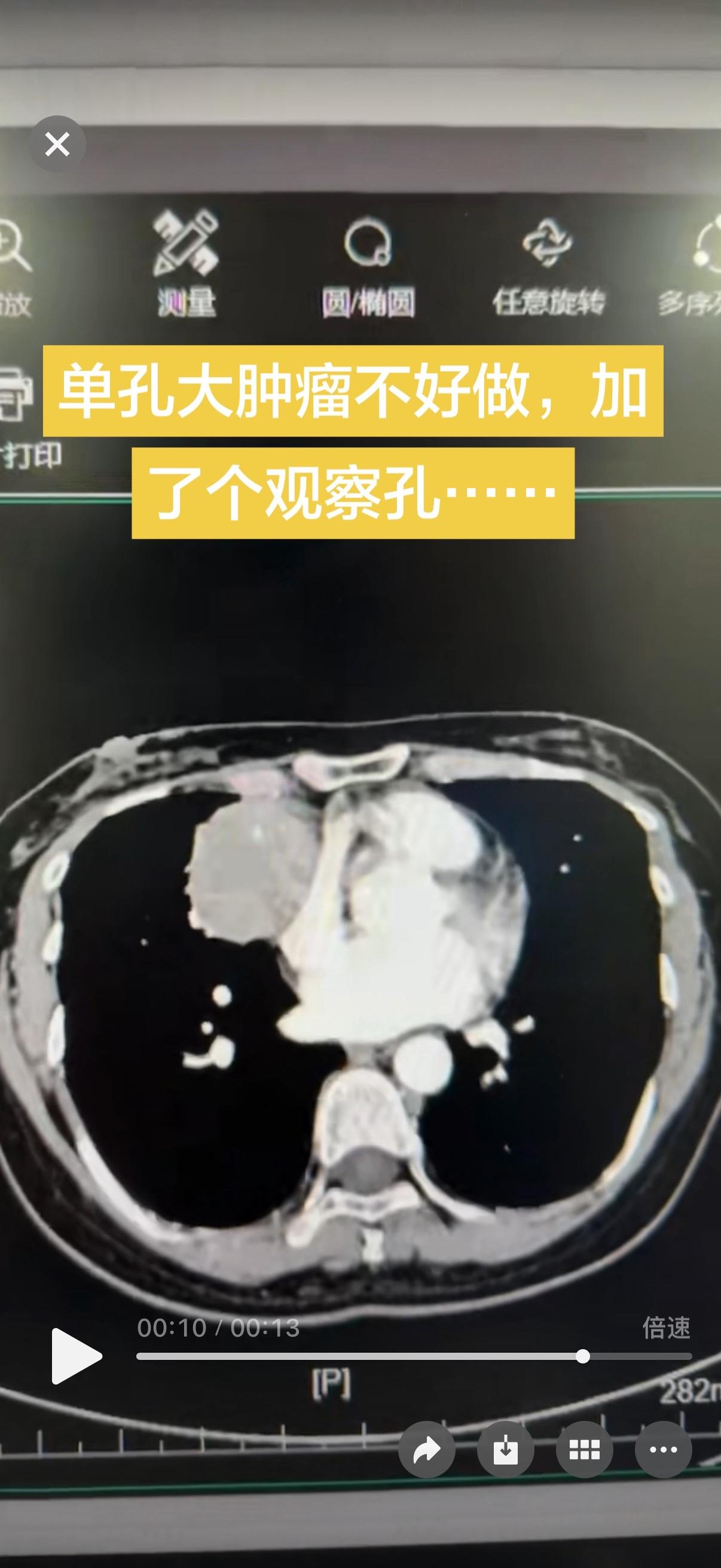 单孔大肿瘤不好做，加了个观察孔，操作孔和观察孔可以互换……增加操作面……
