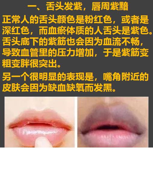 看舌下脉络知道自己是不是血瘀体质，如何活血化瘀？血瘀：简单点理解就是血液流动性差