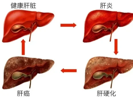 肝癌偏爱的6样食物 平时少吃