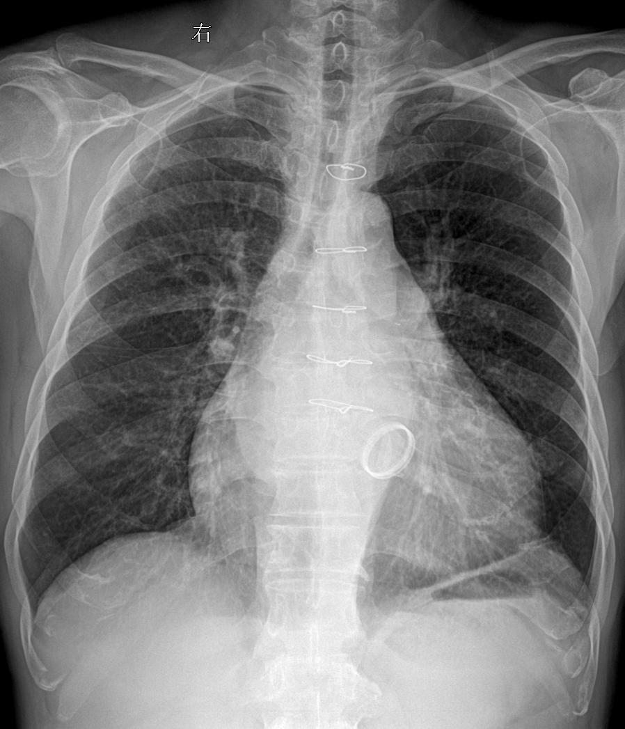 术后胸闷就诊 考虑什么？家银们