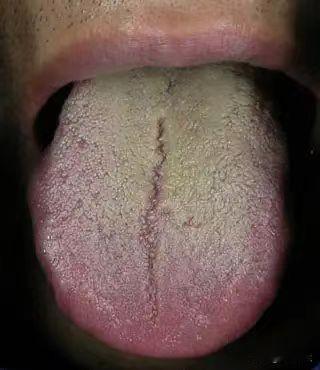 【舌诊分析】小伙子，舌头都这样了，快别吃六味地黄丸了。

昨天接诊了一个患者，阴