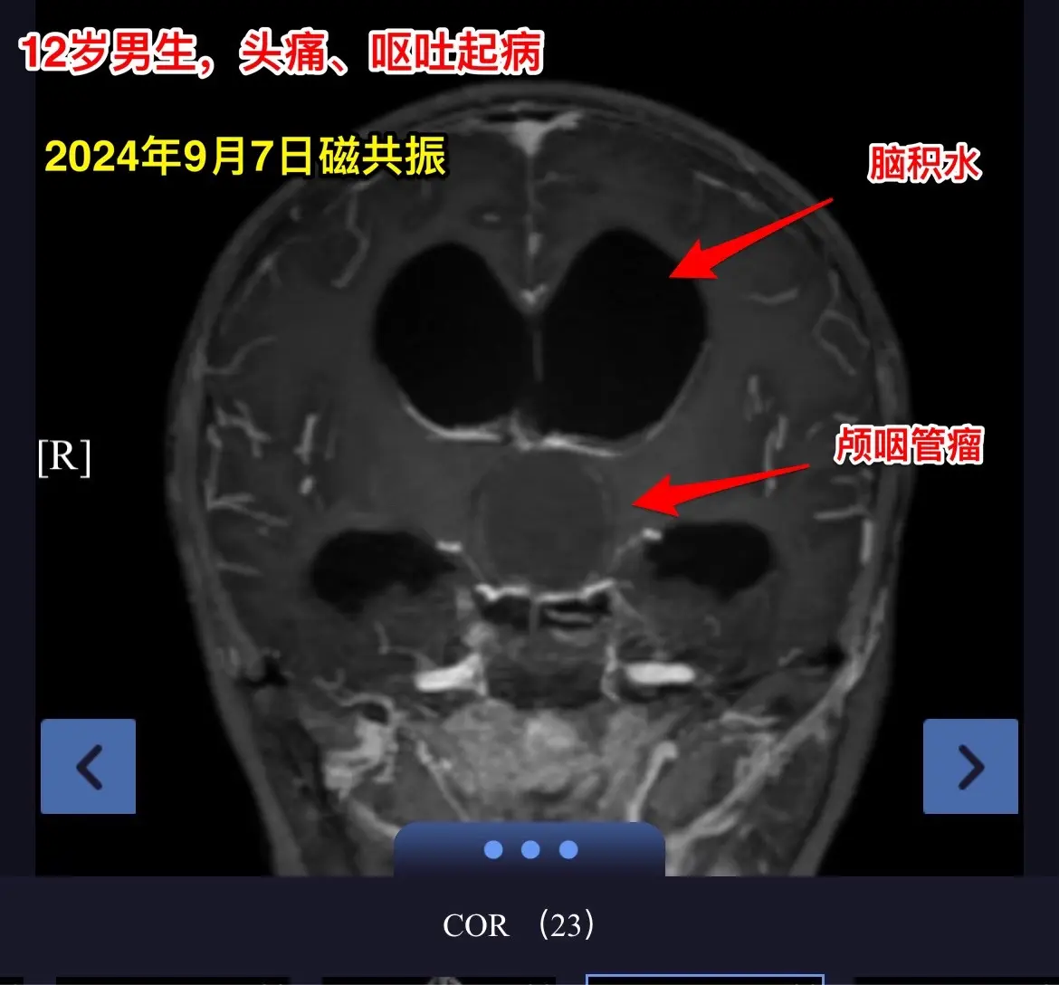 12岁南京男孩子头痛、呕吐。平时感觉身体很好，9月7日因头痛、呕吐到医...