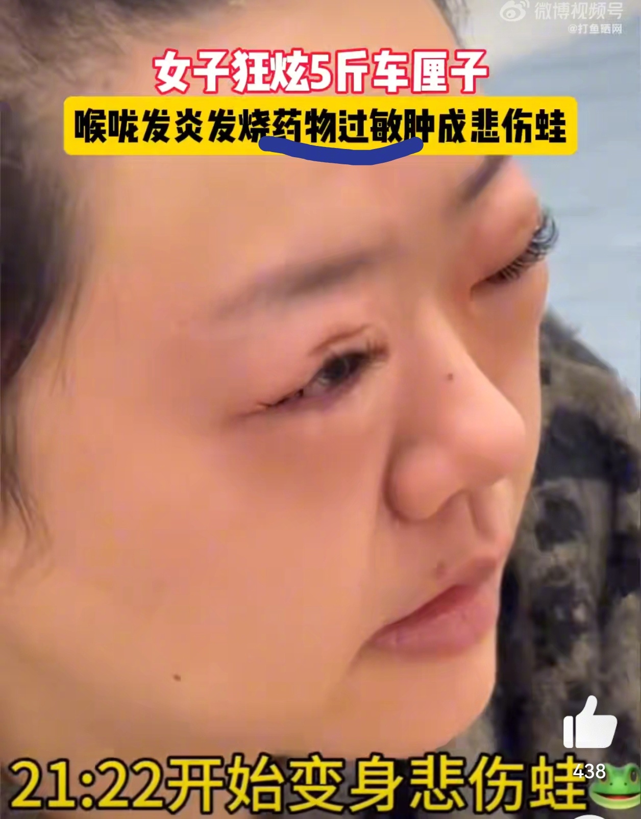 女子吃5斤车厘子过敏肿成悲伤蛙 明明是“药物过敏”，非要西写成“吃5斤车厘子过敏
