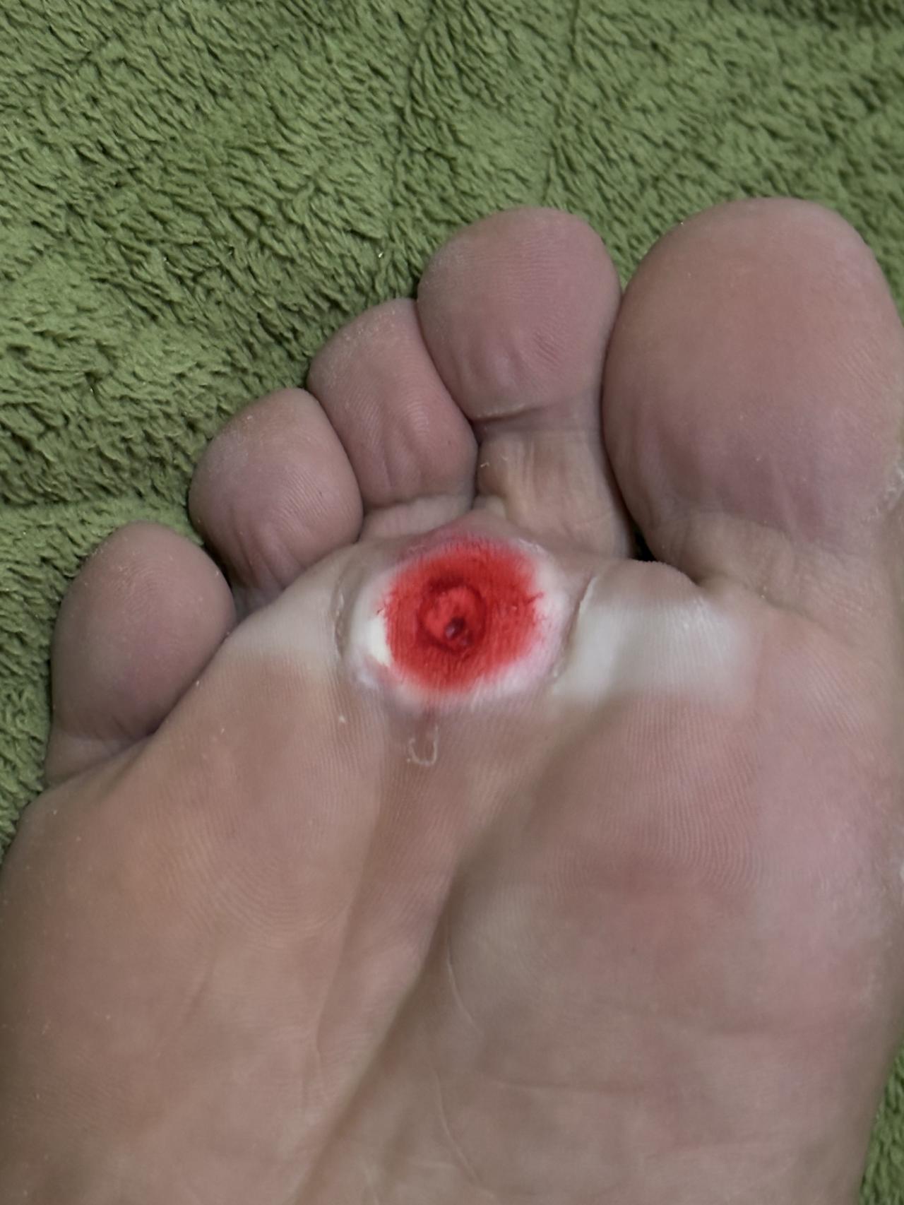 大家帮我看看这是不是鸡眼？

本来打算去医院做冷冻的，想了想，挂号两块冷冻一次5