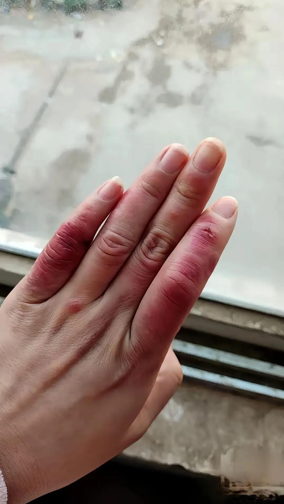 你们有没有什么治疗冻疮的好方法呢？
一到冬天就生冻疮，
捂热了还痒。
听说一旦长