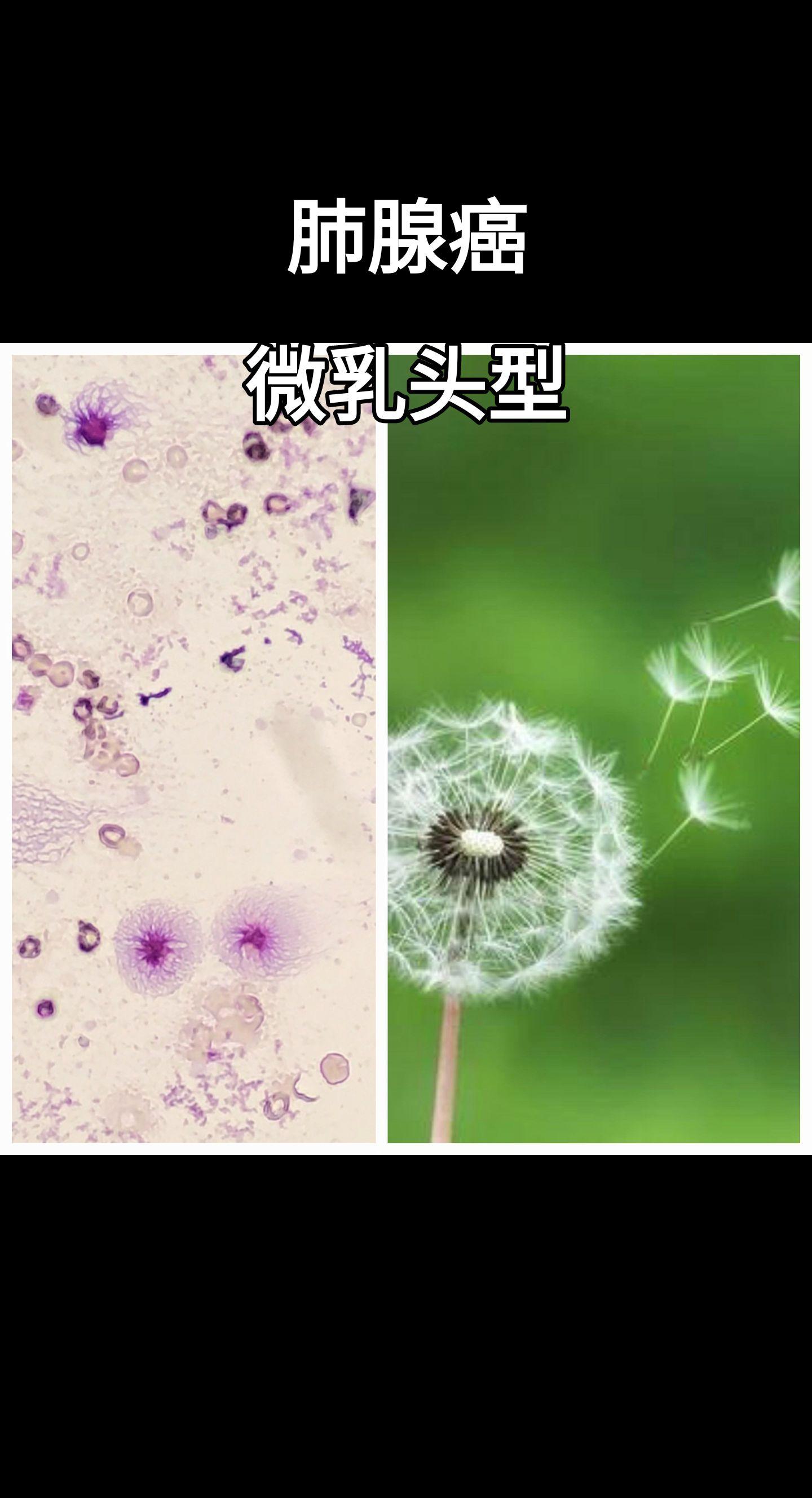 肺腺癌
微乳头