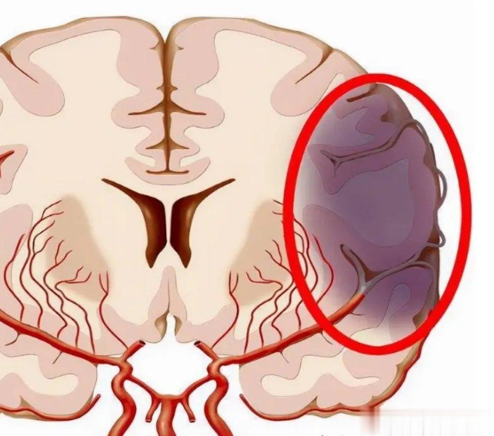 脑梗的二次复发，逃不过四个原因，尤其是第三点1. 情绪过于激动，部分存在脑梗病史