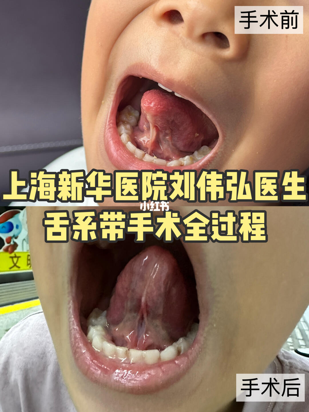 上海新华医院舌系带刘伟弘医生手术详细过程