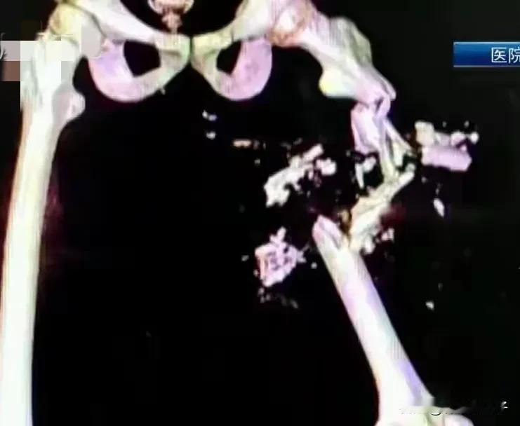 15.75厘米！800天“骨搬运”，让断骨重生的奇迹。
 
谁能想到，腿骨缺损近