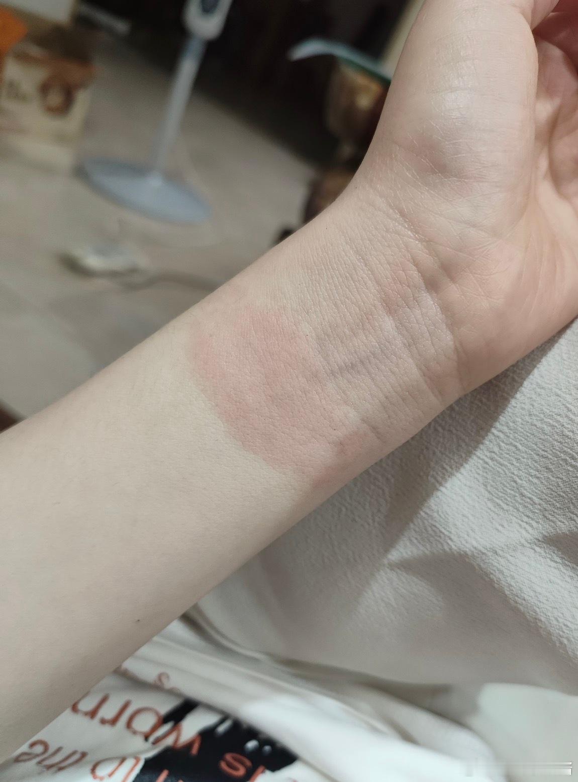运动手环 皮炎有印子是不是扣太紧了？痒可能是你对表带这个材质过敏，也可能是那一块