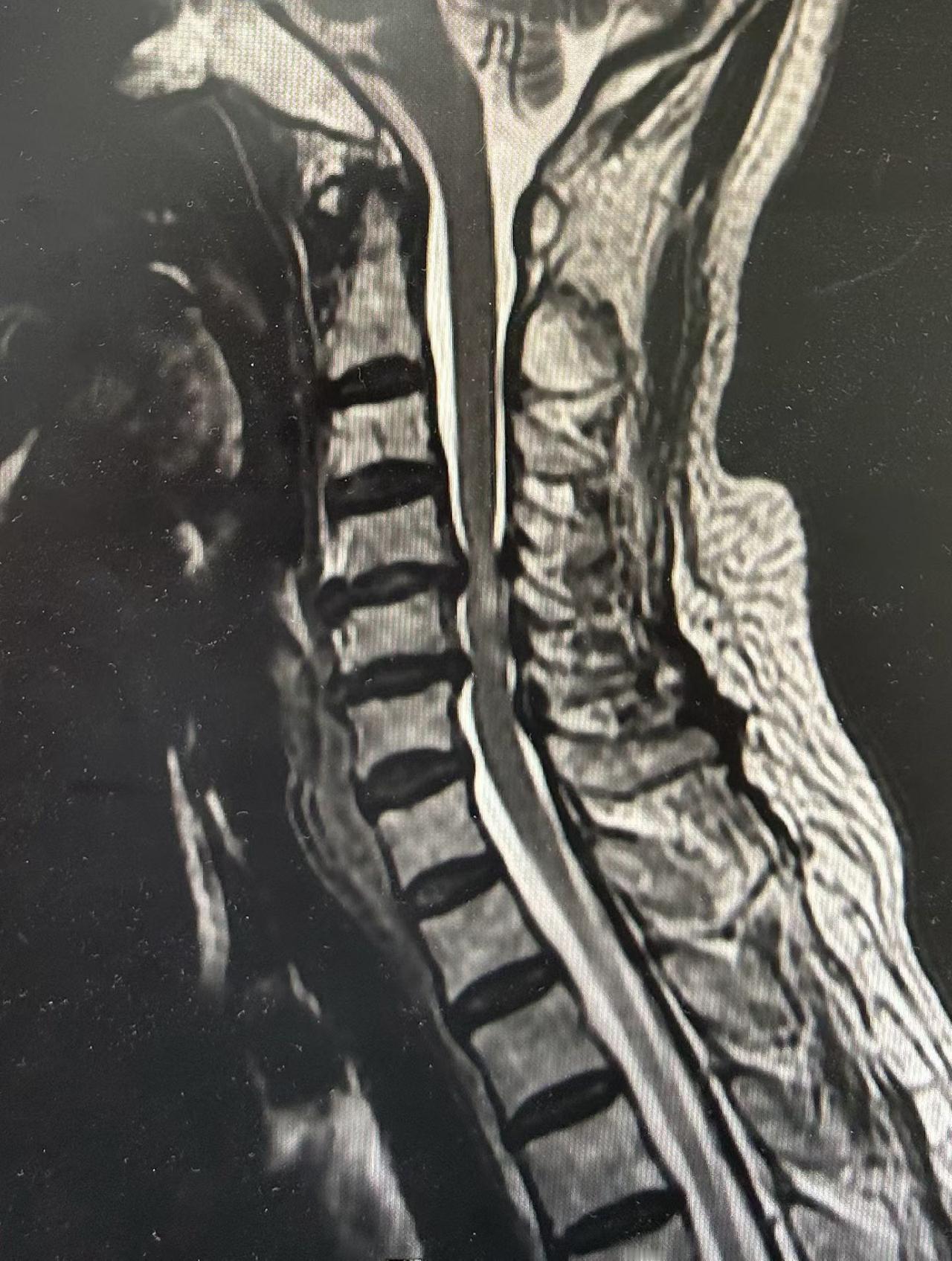 做颈椎最担心的是椎体后缘减压不彻底影响疗效，原因有：椎间隙塌陷，后缘贴合，灯光无