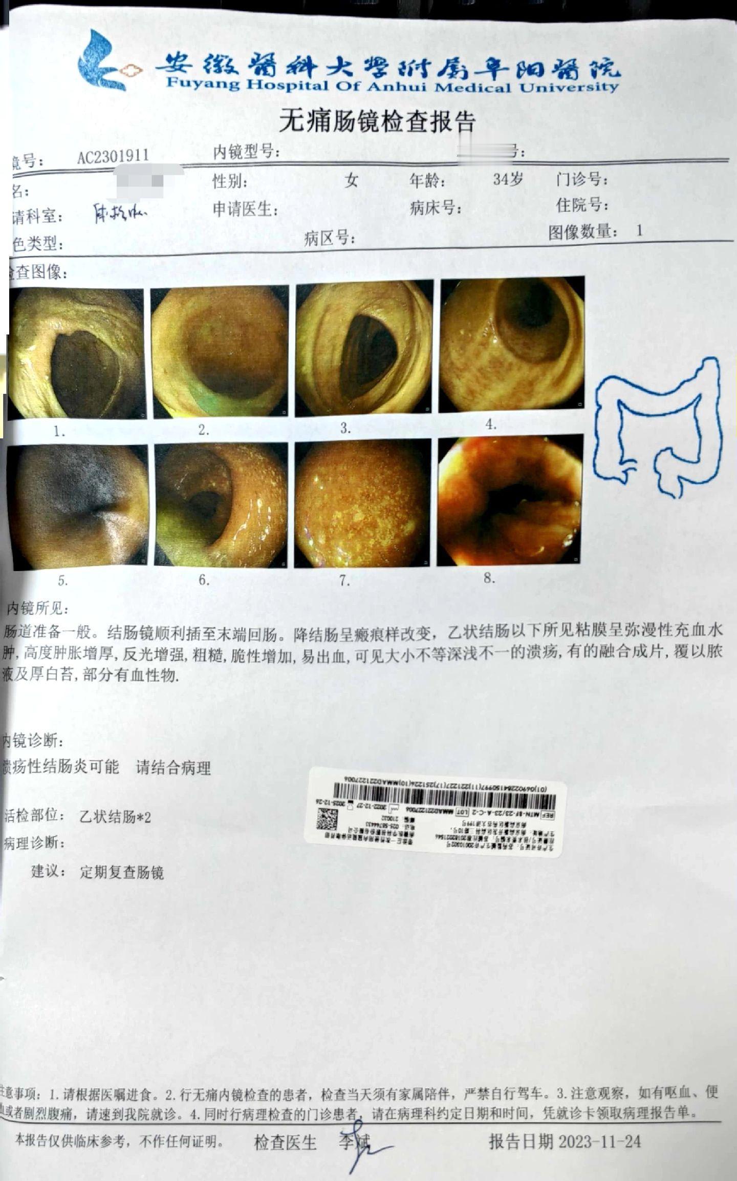 溃疡性结肠炎不能做“无效治疗” 这位患者，全结肠病变，却一直只用栓剂治...