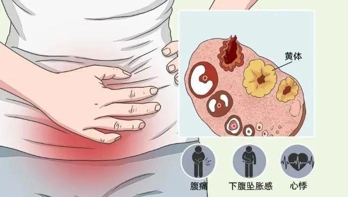 【同房酿成的悲剧：黄体破裂！提醒：夫妻生活别过火】健康真探社近期一则新闻引起了广