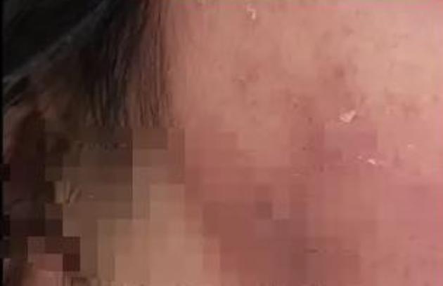 ”7月17日报道，湖南怀化，一女子入住酒店被隐翅虫灼伤全身，酒店却推诿责任！律师