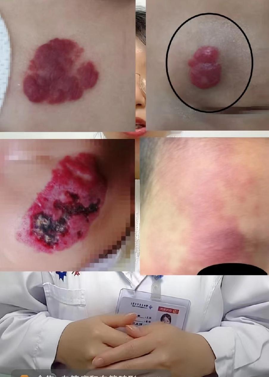 很多人不知道，像椎体血管瘤和肝血管瘤早期大多都没啥症状。椎体血管瘤是椎体骨骼里的