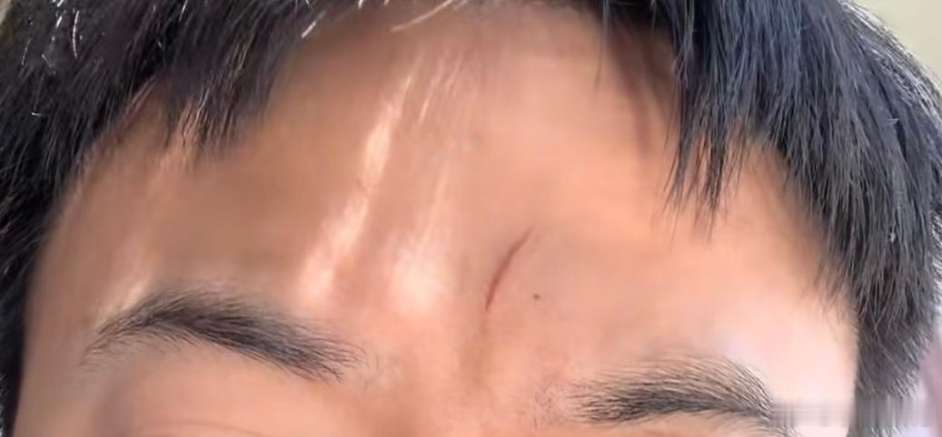 男生，主要是额头有明显的疤、痣，比较深的那种。一是容易结婚早，27岁以前结婚概率