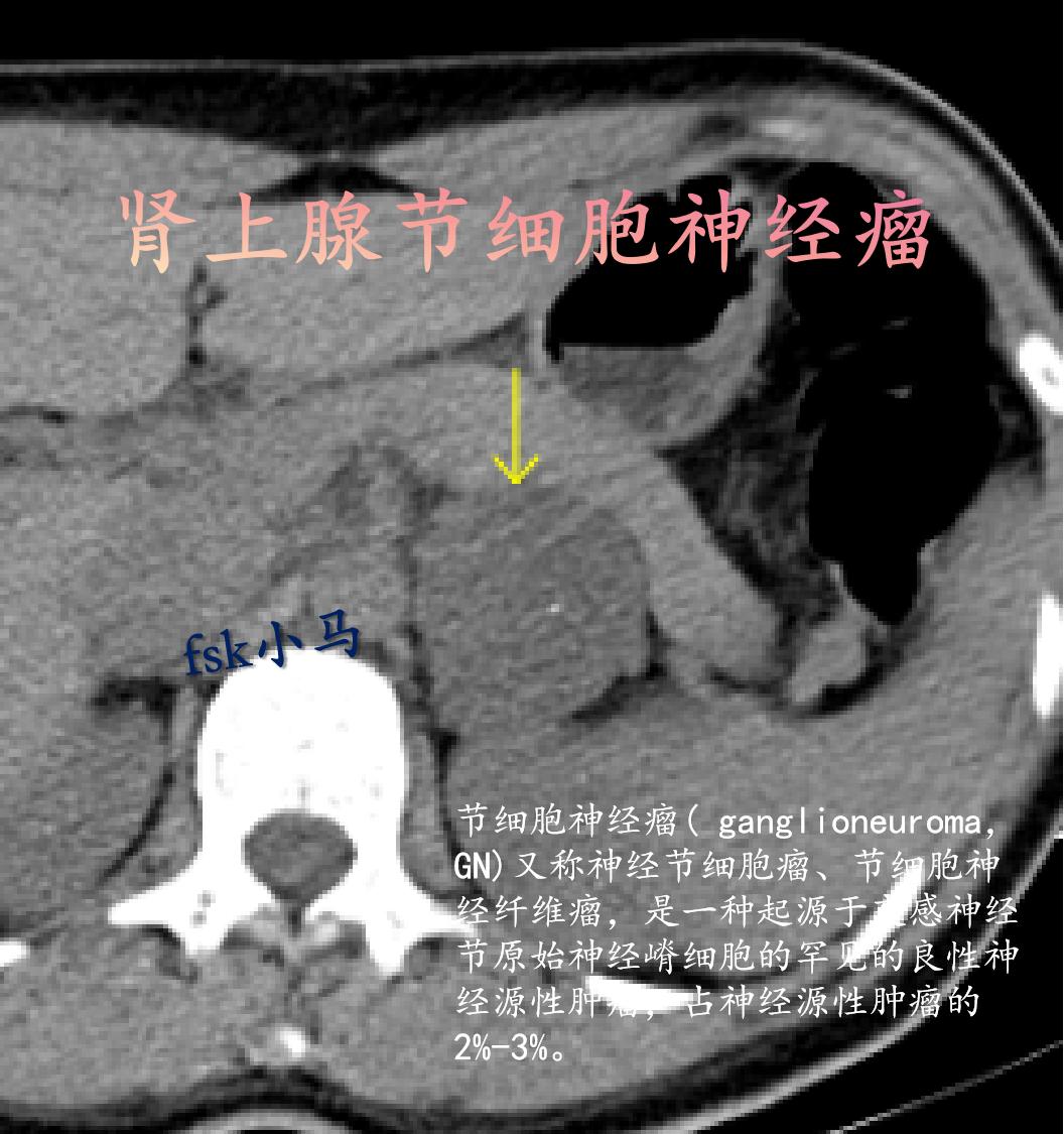 肾上腺节细胞神经瘤