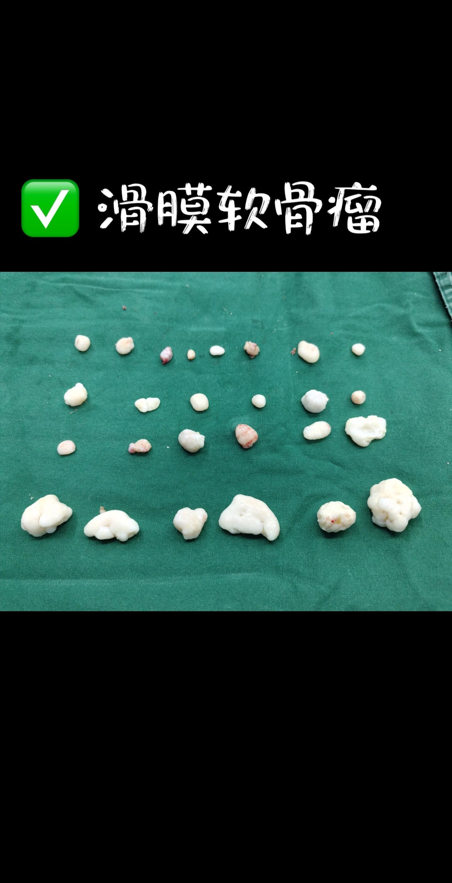 滑膜软骨瘤。膝关节滑膜软骨瘤病3大特征：   1️⃣ 游离体像‘石榴籽...