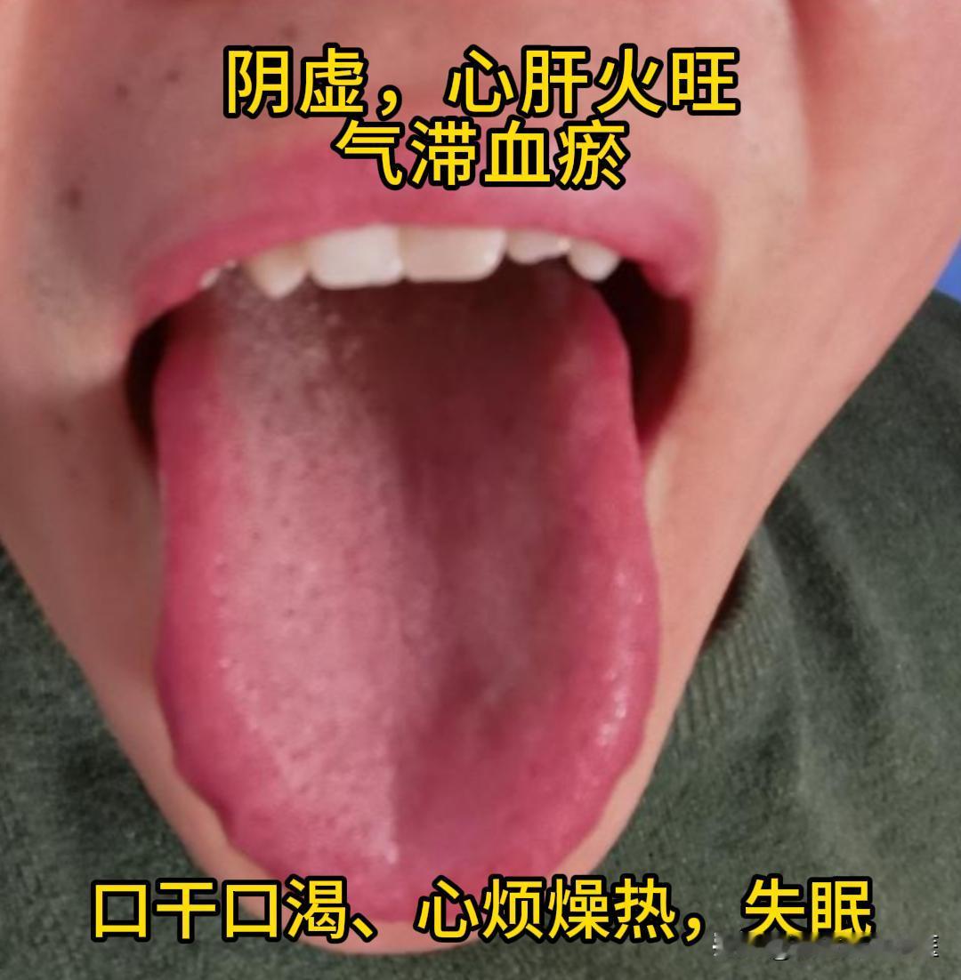 今天有时间，可以帮大家看看舌象。

有需要的，尽管把你的舌象照片发过来吧！越早发