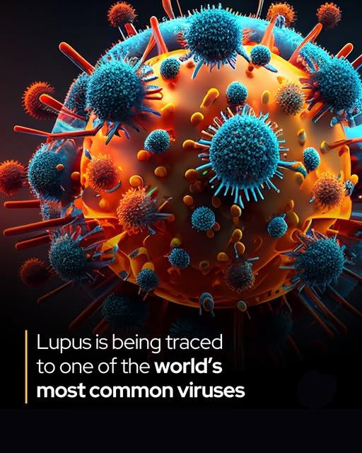 一种常见病毒或为狼疮的根本病因
 
几个世纪以来，狼疮一直是医学领域的未解之谜。