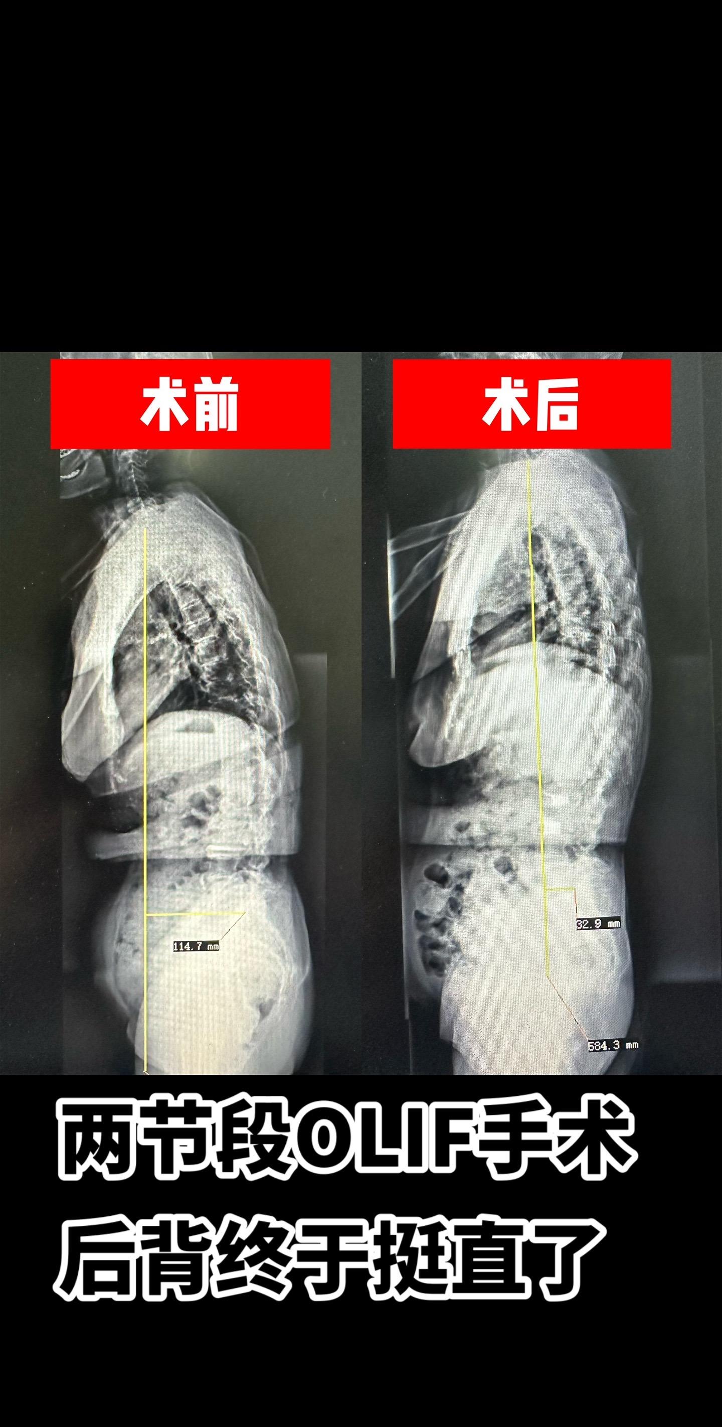 驼背畸形，整个背直不起来，在经历了微创腰椎斜外侧椎间融合术后，背终于挺...