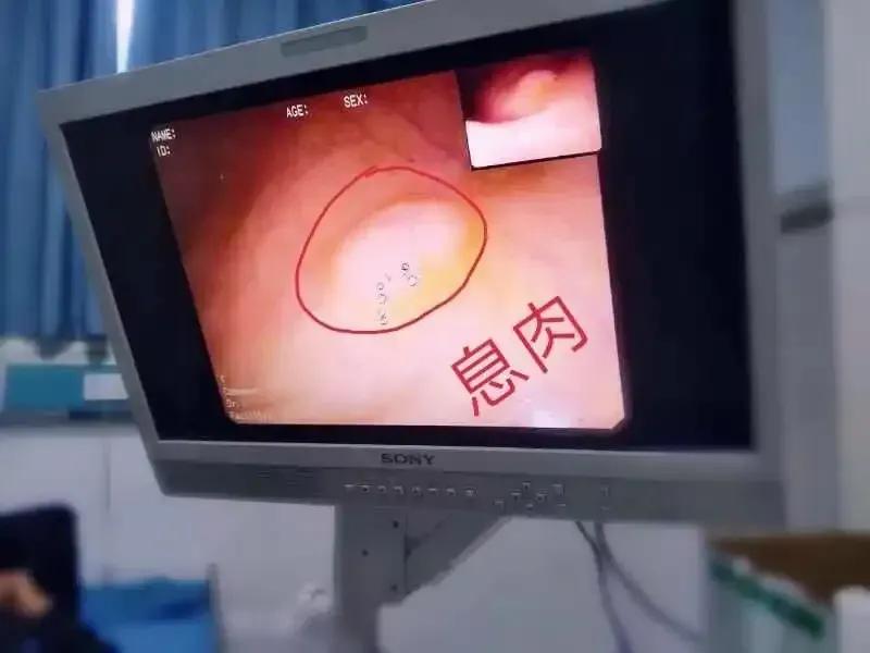 身体里的肌瘤、息肉、囊肿都是痰瘀凝结导致的，今天分享两味中药，化痰散结，专攻这些
