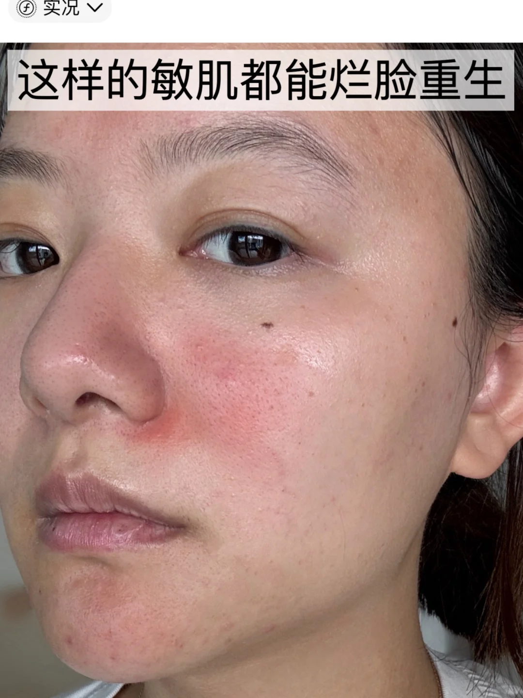 我K找到了一夜摆脱红脸的方法！敏肌重开局