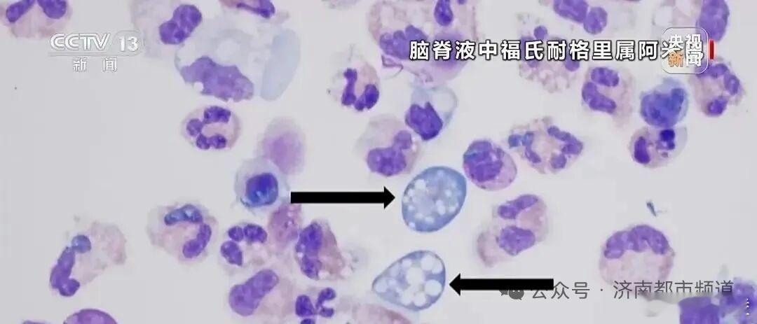 印度食脑虫已致26人死亡  这名字听着像恐怖片剧本，实际是阿米巴原虫作祟，专趁鼻