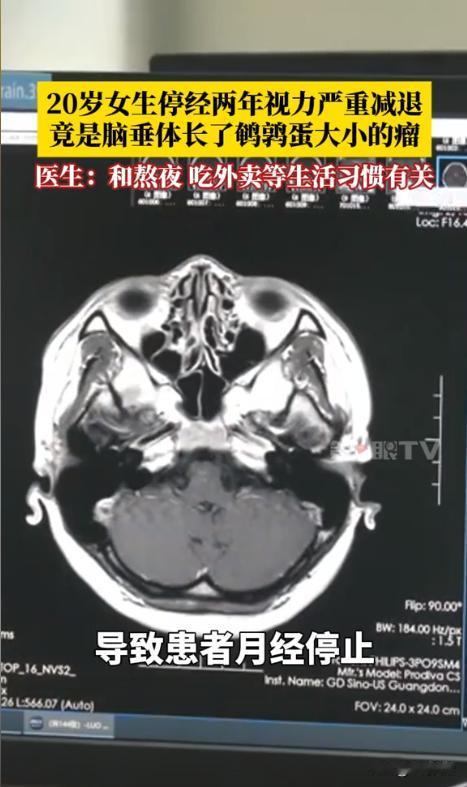 ”看你还敢不敢再吃外卖熬夜了！“一20岁女生平时很喜欢点一些油炸和油盐大的事物吃