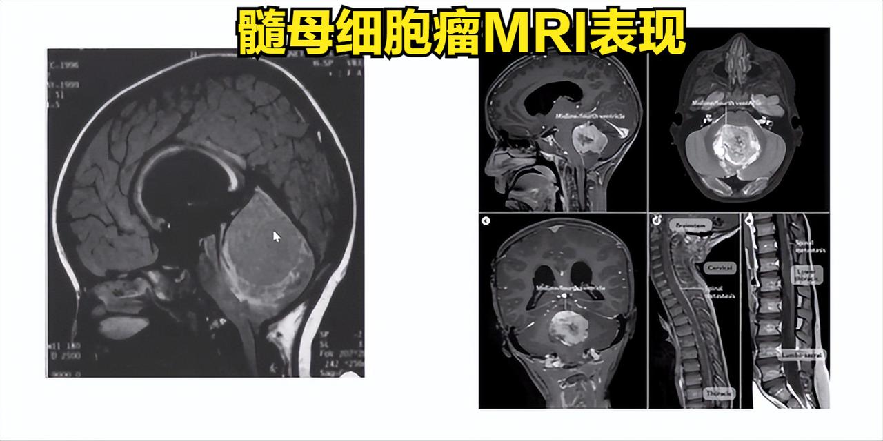 又成功一例！近日，我院应用最新一代精准智慧化放疗系统——Halcyon“速锐刀”