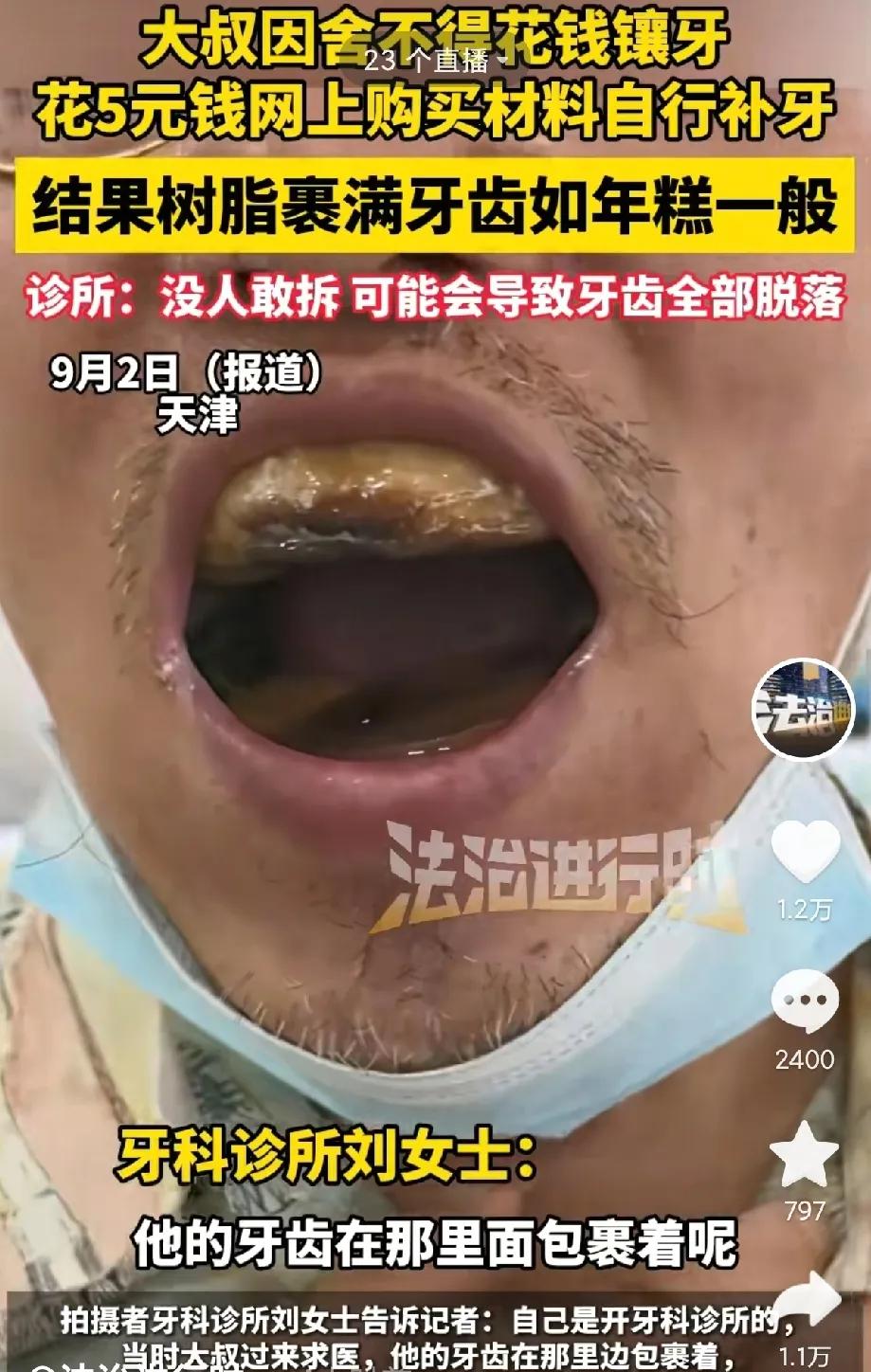 太惨了！大叔舍不得花钱补牙，就在网上花5元买树脂材料自己补牙，谁料，树脂慢慢包裹