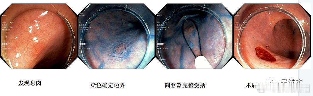 内镜下息肉冷切除术（CSP）[心]用于直径<10 mm的非癌性非带蒂结直肠息肉。