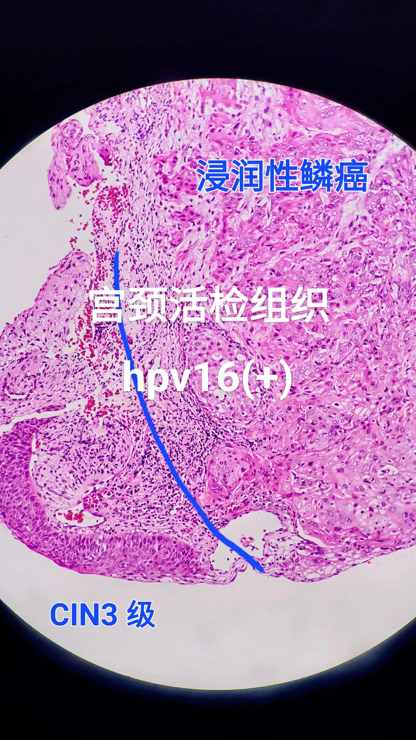 hpv感染 宫颈癌