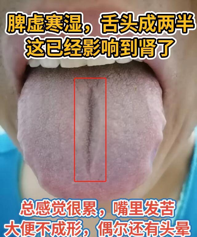 三种舌象分析 看看你是哪种