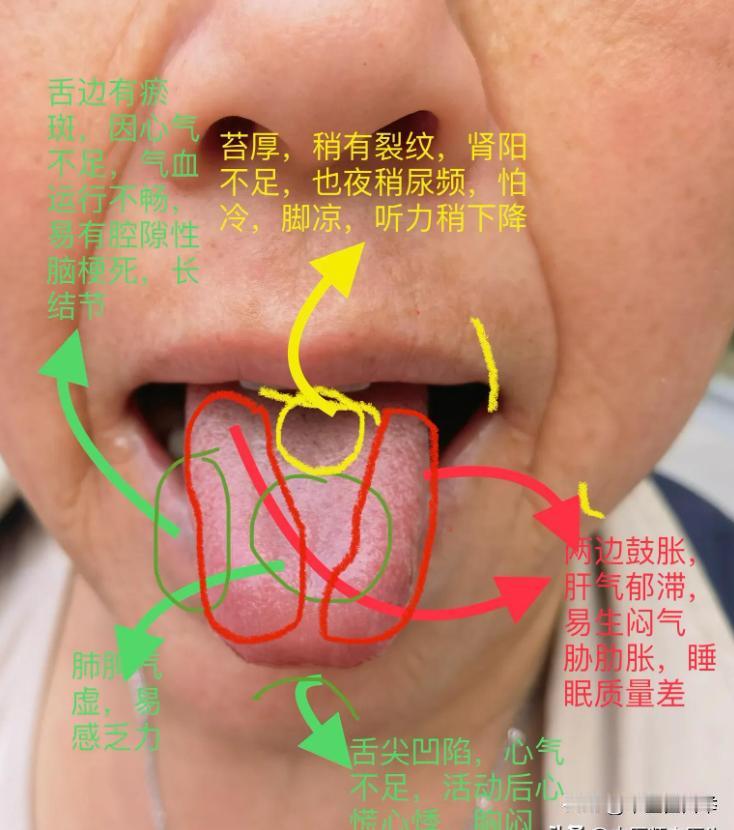 有粉丝好奇，崔医生看舌象怎么看的这么准呢？
今天就给大家分享几个详细的分析图
看