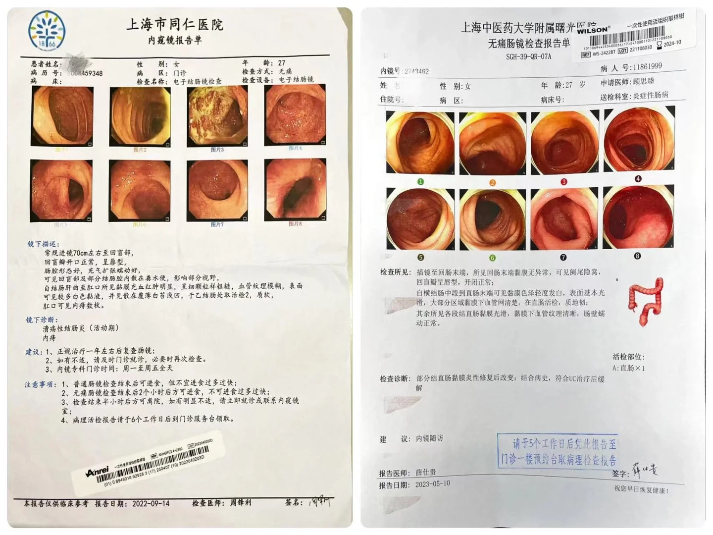 肝曲以下病变溃结患者治疗近2年黏膜愈合。