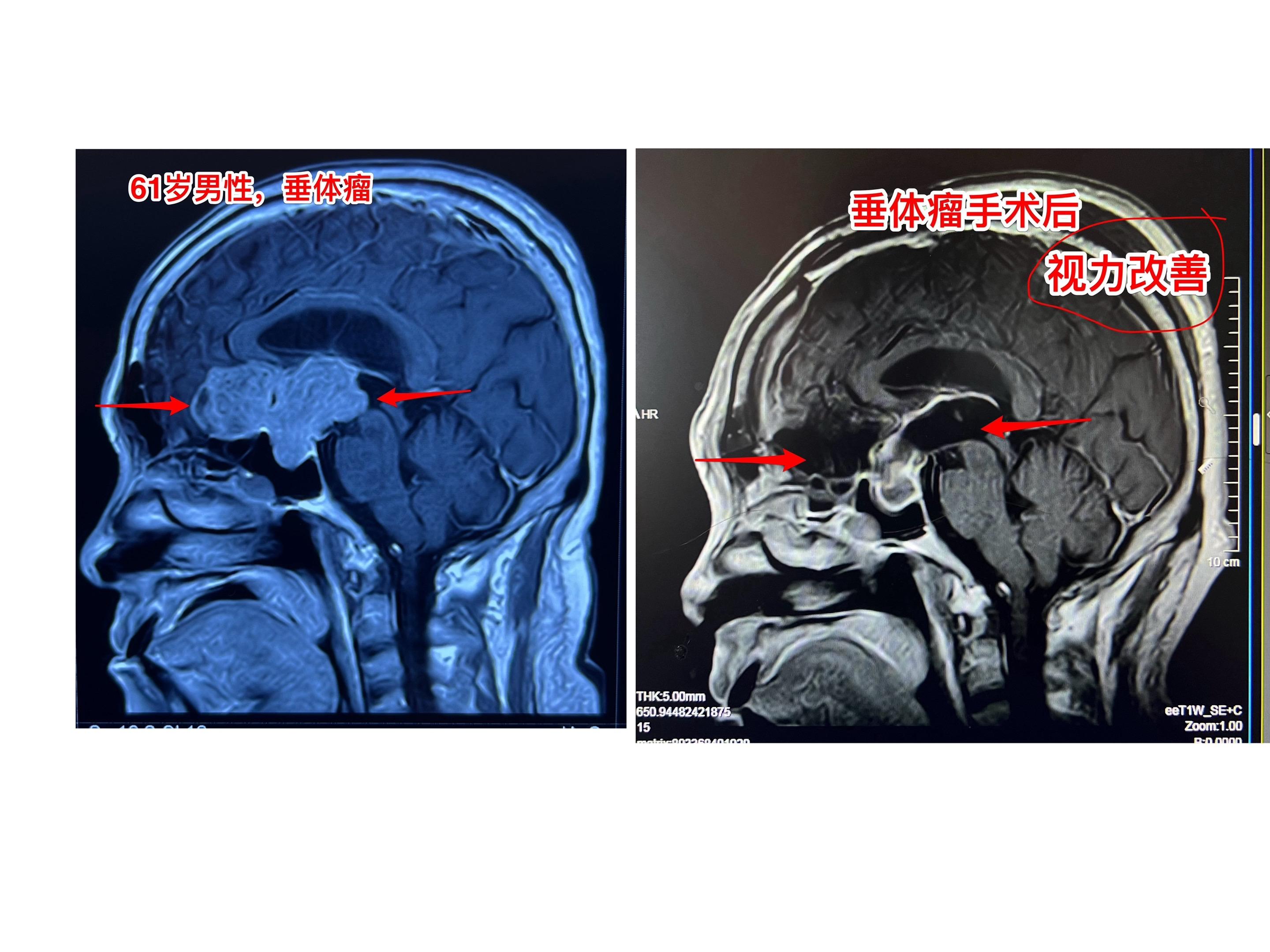巨大垂体瘤手术前后磁共振对比 61岁张家口男性，视力下降伴头痛。经磁共...