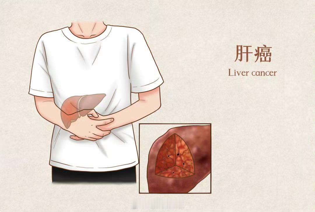 小伙把腹胀当胃病查出肝癌晚期很多年轻人都有一个误区就是熬夜、奶茶、烧烤这些事情，