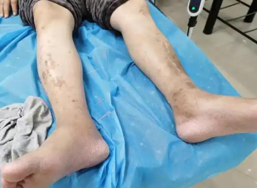 成功护骨后，骨头还能恢复坚硬吗？建议：补维D别超过这个岁数

说到骨骼健康，很多