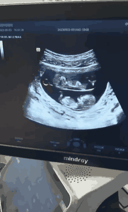 这双胞胎在妈妈肚子里就分上下铺了？
##
这么小就有独立精神了？
##
未分娩就