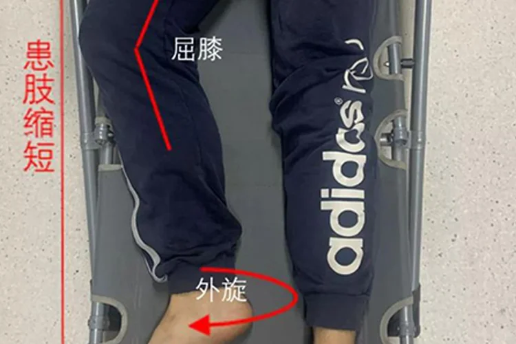 股骨颈骨折图片